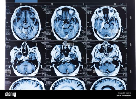 the villages mri head scan